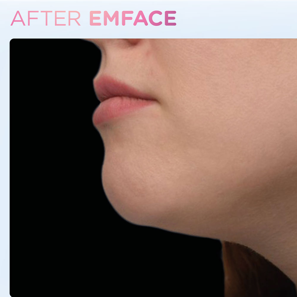 EMFACE-After---Full-Life-Wellness-Center-Florence-AL