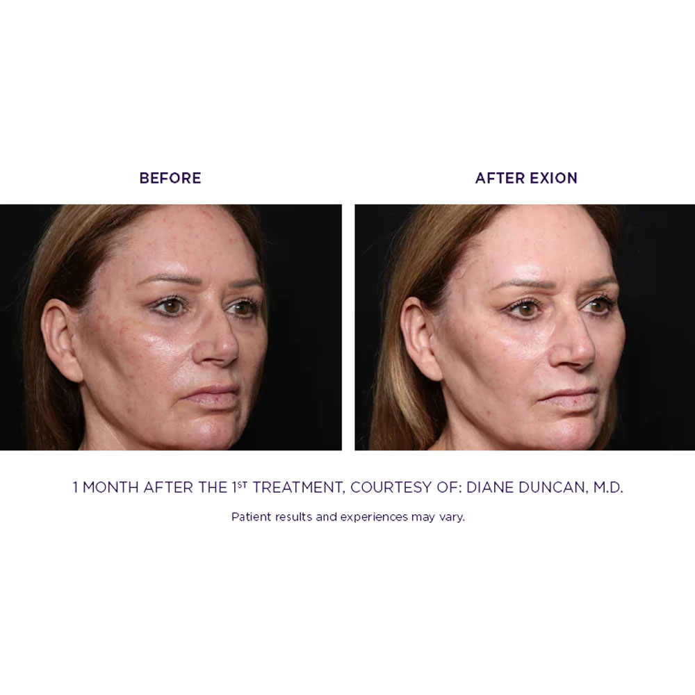 EXION-Before-After---Full-Life-Wellness-Center-Nashville-TN