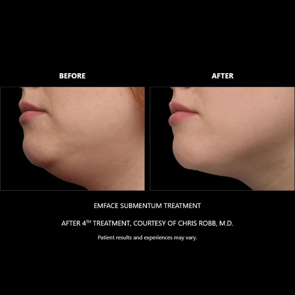 EXION-Before-After---Full-Life-Wellness-Center-Nashville-TN