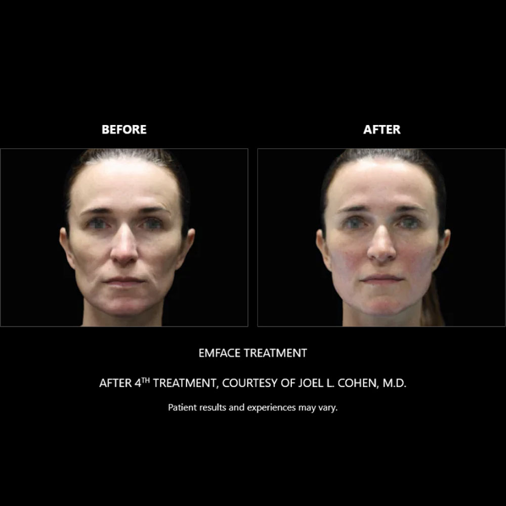 EXION-Before-After---Full-Life-Wellness-Center-Nashville-TN